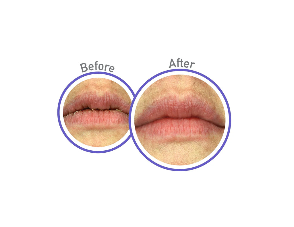 Night Treatment Balm for Dry, Cracked Lips - 0.25 Oz (2 Pack)