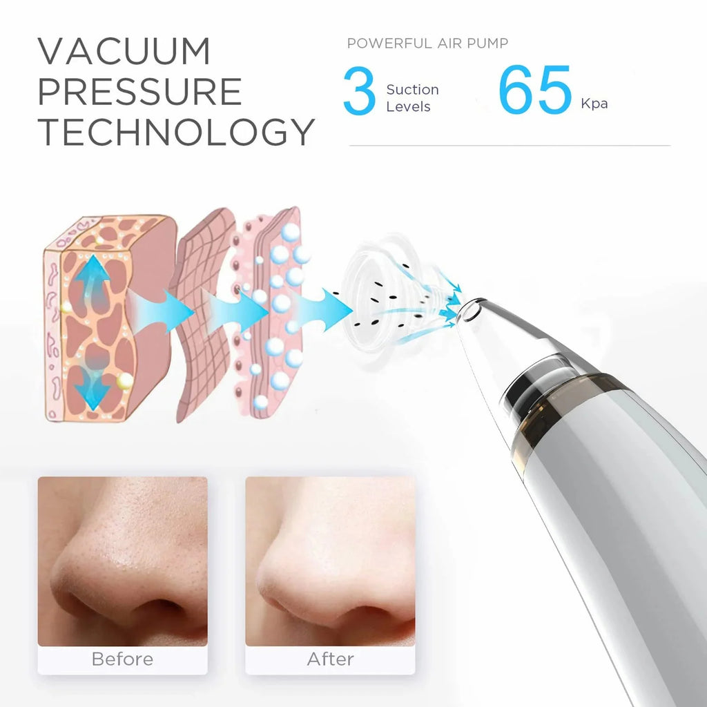 Advanced Blackhead Remover Vacuum - USB Rechargeable Pore Cleaner with 5 Probes for Flawless Skin