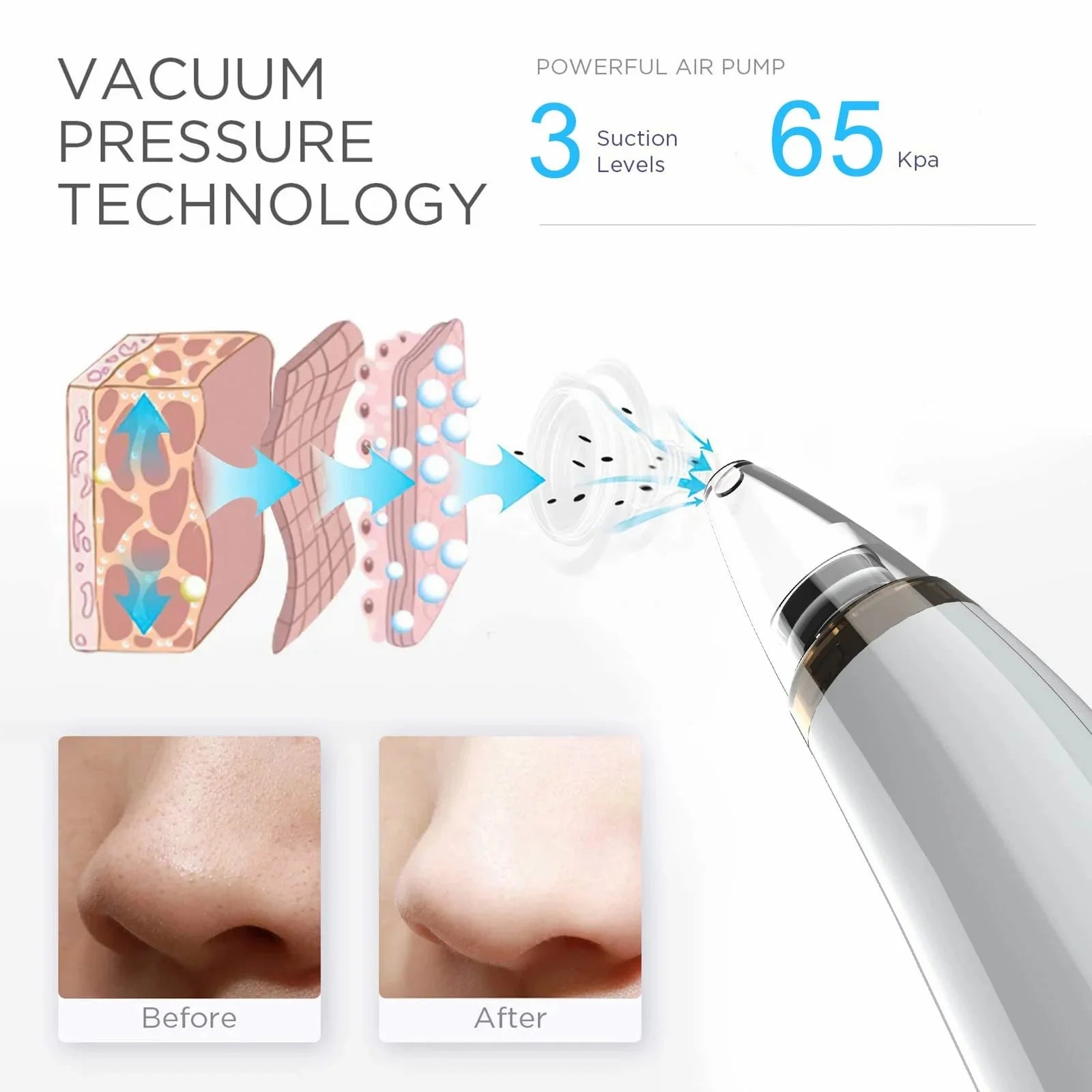 Advanced Blackhead Remover Vacuum - USB Rechargeable Pore Cleaner with 5 Probes for Flawless Skin